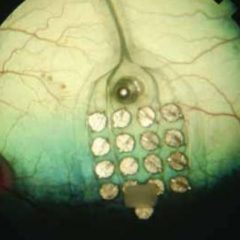 Imagem da notícia: Olhos bi&oacute;nicos chegam ao mercado