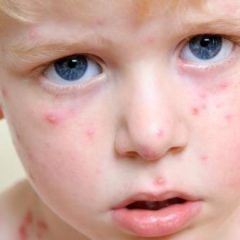 Imagem da notícia: Sarampo pode trazer complicações à visão